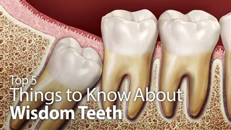 5 Things To Know About Wisdom Teeth Springvale Dental Clinic