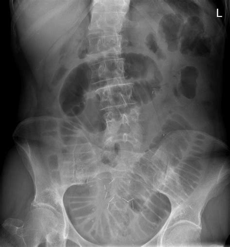 Small Bowel Obstruction Adhesions Radiology At St Vincents