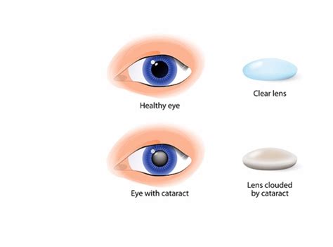 Cataract Applecross Eye Clinic
