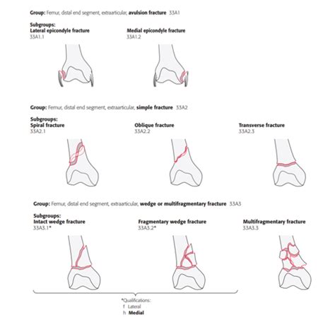 Ao Classification Of Distal Femur Fractures Radiology Reference Hot