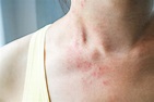 A rash is a common symptom of anxiety
