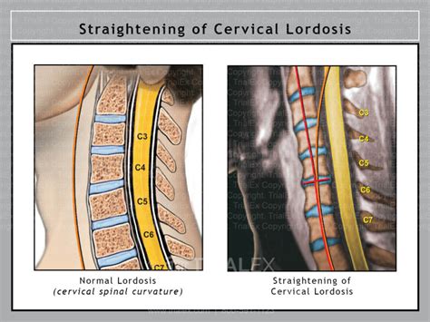 Straightening Of Cervical Lordosis Trial Exhibits Inc