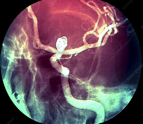 Aneurysm Treatment Angiogram Stock Image M7250456 Science Photo