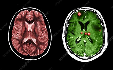 Mri Of Normal And Tumour Filled Brains Stock Image C0272415