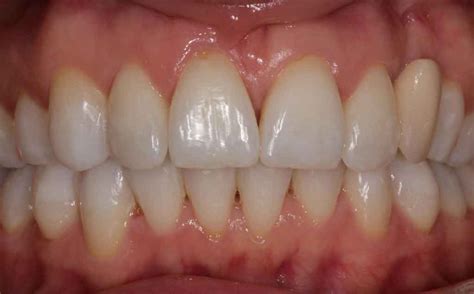 Another Delighted Invisalign Client Dentist Leeds Fhdc