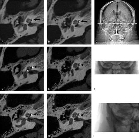 Flat Panel Ct For Cochlear Implant Electrode Imaging Compar