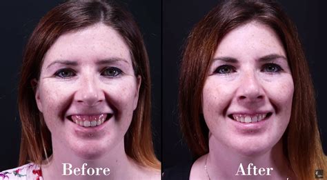 Gummy Smile Treatment Victorian Cosmetic Institute