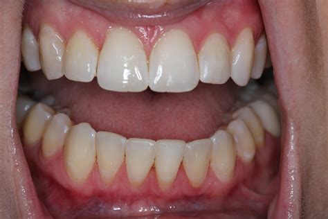 Case Study Invisalign For Over Crowding Southview Dentistry