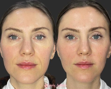 Smile Lift Treatment With Fillers Benefits Costs Results And Procedure Steps