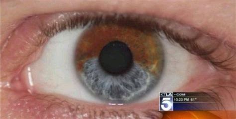 Laser Surgery That Can Permanently Change Eye Color The