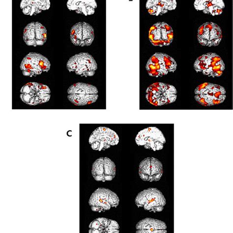 Brain Regions Activated During The Angry Face Condition In Reference To