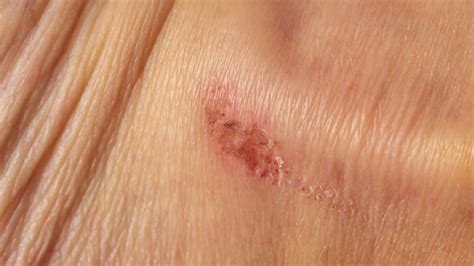 Impetigo Symptoms Causes Treatments Clear Skin Clinic