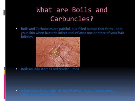 Ppt Boils And Carbuncles Powerpoint Presentation Id1841974