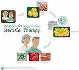 Stem Cell Therapy Risks And Benefits Pictures