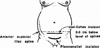 Figure 6 from The Misgav Ladach Method of Caesarean Section: Evolved by ...