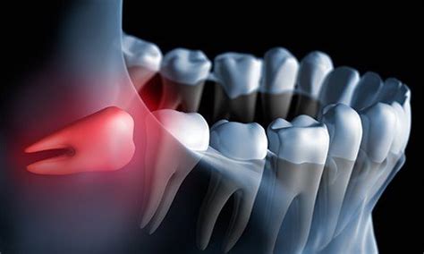 Wisdom Tooth Extraction Worcester Emergency Dentist University