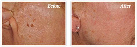 Seborrheic Keratosis Removal New Orleans Skin Growth Treatments