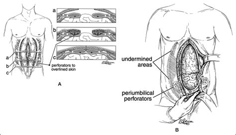 Challenging Abdominal Wall Defects The American Journal Of Surgery