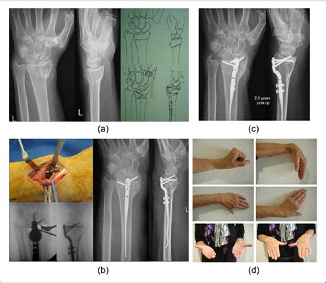 A Less Invasive Distal Osteotomy Of The Radius For Malunited Dorsally