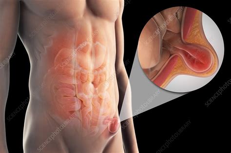 Inguinal Hernia Artwork Stock Image C0206655 Science Photo Library