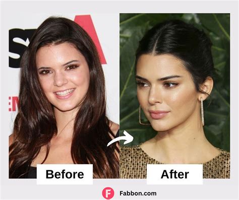 Revealed Kendall Jenner Plastic Surgery Secrets Before And After Photos Fabbon