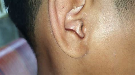 How Earwax Is Professionally Extracted Rock Hard Ear Wax Stuck To