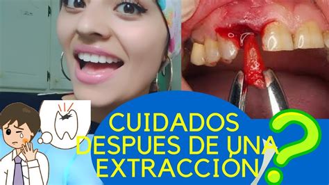 Cuidados Después De Una ExtracciÓn Dental Youtube