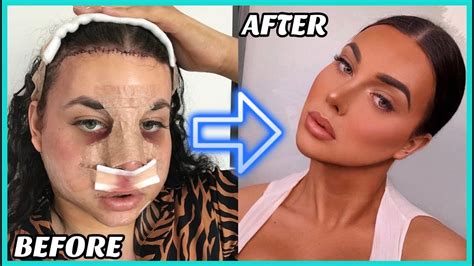facial feminization before and after pictures telegraph
