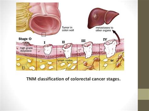 Malignant And Benign Tumors The Stages And Grading Of Tumor Type