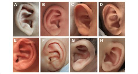 Typical Results Of The Earwell Ear Molding For Different Types Of Ear