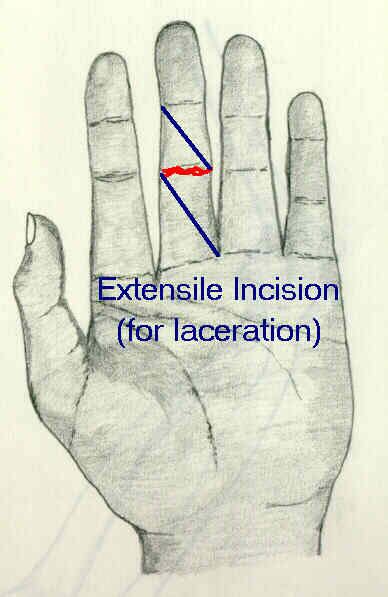 Finger And Hand Incisions Wheeless Textbook Of Orthopaedics