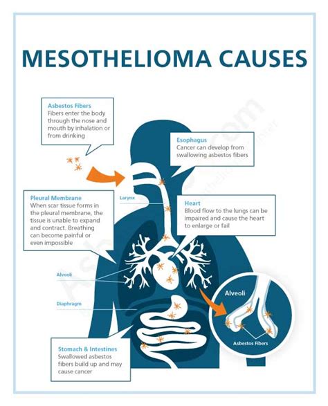 Mesothelioma Causes And Risk Factors Asbestos Exposure