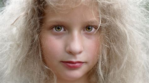 Uncombable Hair Syndrome Causes Treatment And What It Is