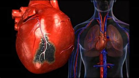 The reduced blood flow is usually the result of a partial or complete blockage of your heart's arteries (coronary arteries). Myocarditis | Medical diagnosis