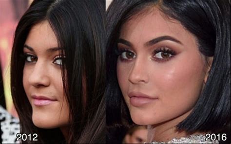 Kylie Jenner Before And After 😱 All Of Her Plastic Surgery