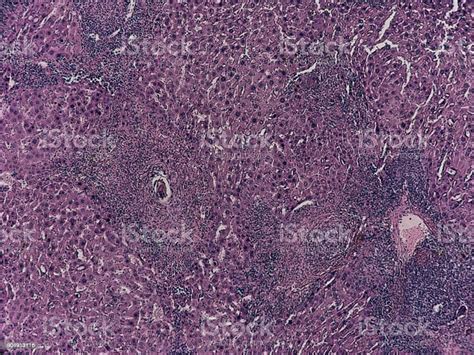 Human Pathology Foreign Body Granulome With Hemosiderin And Giant Cells