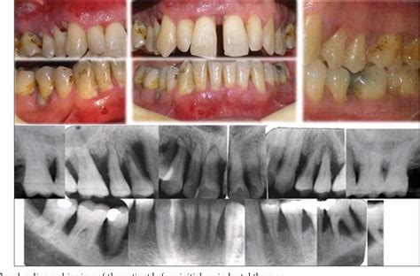 Figure 1 From Periodontal Treatment In A Generalized Severe Chronic