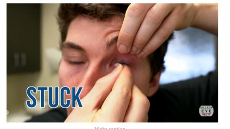 How To Remove A Stuck Contact Lens Doctor Eye Health