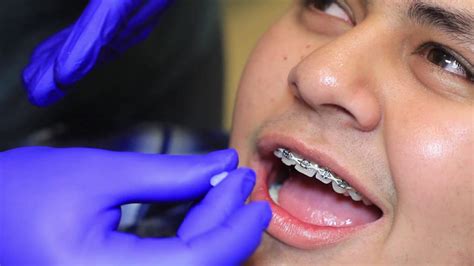 How To Use Wax Braces And Invisalign In Okc Sky Ortho Youtube