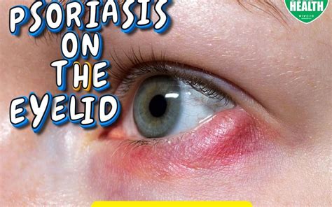 Psoriasis On The Eyelid Understanding Symptoms Causes And Effective