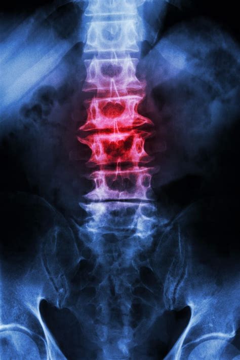The purpose of this study was to assess the application of the radiographic index method to analyze the radiographic features of. Spondylosis Center - Spinal Osteoarthritis - Symptoms ...