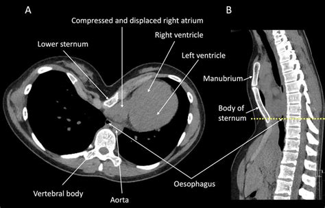 A Transverse Ct Scan At A Level Of The Lower Chest And B Sagittal