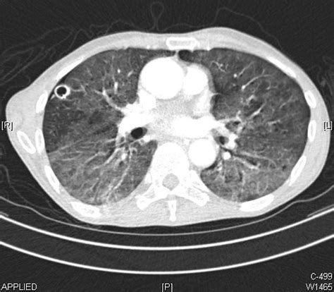 Lung Abscess Ct Scan The Thick Walled Cavitary Lesion In Flickr