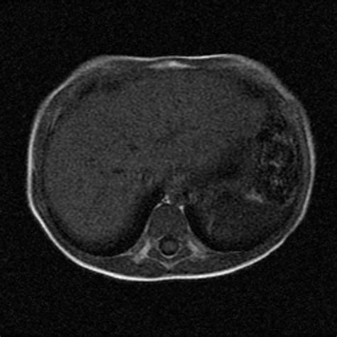 Multicystic Dysplastic Kidney On Left Radiology Case