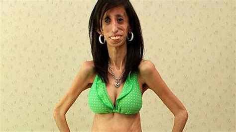 Skinniest Woman In The World Has To Eat Every Minutes Lizzie Velasquez Youtube