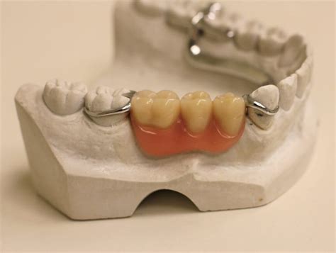 Dentures Full And Partial False Teeth Options And Costs Uk