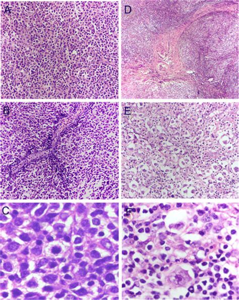 Histologic Features Of Lymphomas Observed Via H E Staining A Diffuse