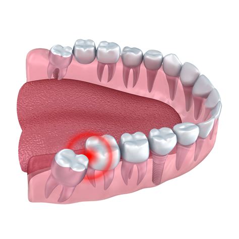 When To See A Dentist For An Emergency Tooth Extraction Trulite Led