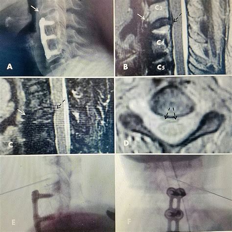 Cureus Minimally Invasive Anterior Cervical Discectomy Without Fusion