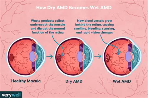 How Dry Amd Becomes Wet Amd